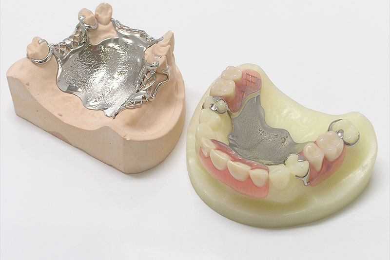にいつま歯科　入れ歯・義歯　コバルトクロム義歯